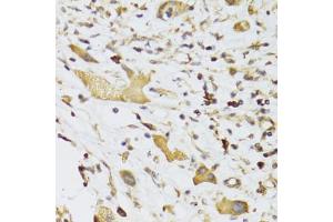 Immunohistochemistry of paraffin-embedded human liver cancer using GPD2 Antibody (ABIN5973974) at dilution of 1/100 (40x lens). (GPD2 anticorps)