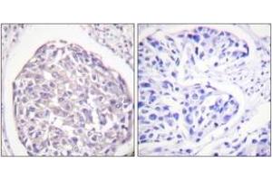 Immunohistochemistry analysis of paraffin-embedded human breast carcinoma, using IR (Phospho-Tyr1355) Antibody. (IR (AA 1326-1375), (pTyr1355) anticorps)