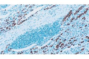 Human lung adenocarcinoma: immunohistochemical staining for Surfactant Protein A. (Surfactant Protein A1 anticorps)