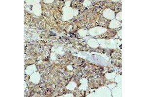 Immunohistochemical analysis of HER2 staining in human breast cancer formalin fixed paraffin embedded tissue section. (ErbB2/Her2 anticorps)