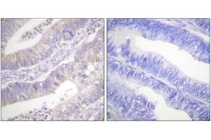 Immunohistochemistry analysis of paraffin-embedded human colon carcinoma tissue, using CFTR (Ab-737) Antibody. (CFTR anticorps  (AA 711-760))