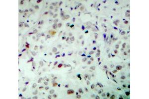 Immunohistochemistry (IHC) image for anti-Retinoblastoma 1 (RB1) (pSer780) antibody (ABIN1870571) (Retinoblastoma 1 anticorps  (pSer780))