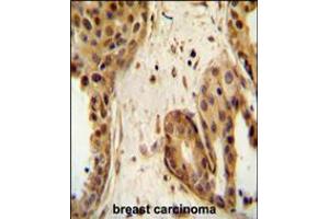 STAT2 Antibody immunohistochemistry analysis in formalin fixed and paraffin embedded human breast carcinoma followed by peroxidase conjugation of the secondary antibody and DAB staining. (STAT2 anticorps  (C-Term))