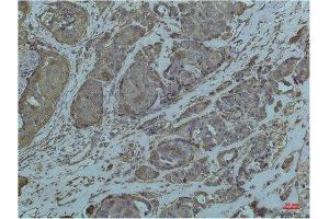 Immunohistochemistry (IHC) analysis of paraffin-embedded Human Breast Carcicnoma using GRP78/Bip Mouse Monoclonal Antibody diluted at 1:200. (GRP78 anticorps)