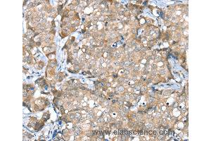 Immunohistochemistry of Human breast cancer using SESN2 Polyclonal Antibody at dilution of 1:30 (Sestrin 2 anticorps)