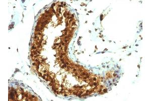 Formalin-fixed, paraffin-embedded human Testicular Carcinoma stained with SUMO-1 Monoclonal Antibody (SUMO1/1188) (SUMO1 anticorps)