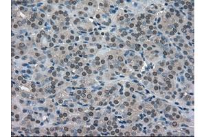 Immunohistochemical staining of paraffin-embedded Adenocarcinoma of ovary tissue using anti-SOD1mouse monoclonal antibody. (SOD1 anticorps)