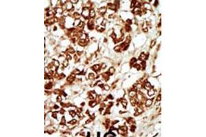 Formalin-fixed and paraffin-embedded human cancer tissue reacted with the primary antibody, which was peroxidase-conjugated to the secondary antibody, followed by AEC staining. (ZAK anticorps  (AA 271-300))