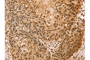 The image on the left is immunohistochemistry of paraffin-embedded Human esophagus cancer tissue using ABIN7131133(SNX8 Antibody) at dilution 1/25, on the right is treated with fusion protein. (SNX8 anticorps)