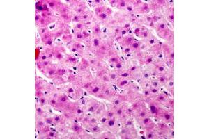 Immunohistochemical analysis of Complement C9 staining in human liver cancer formalin fixed paraffin embedded tissue section. (C9 anticorps  (Center))