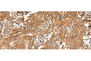 Immunohistochemistry of paraffin-embedded Human cervical cancer tissue using GFI1 Polyclonal Antibody at dilution of 1:100(x200) (GFI1 anticorps)