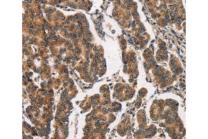 Immunohistochemistry of Human breast cancer using ITGA2 Polyclonal Antibody at dilution of 1:30 (ITGA2 anticorps)