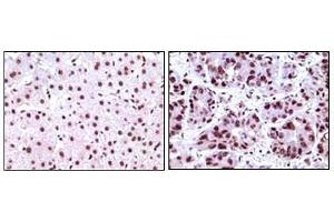 Immunohistochemical analysis of paraffin-embedded human liver carcinoma tissues, showing nuclear localization using NPM antibody with DAB staining. (NPM1 anticorps)
