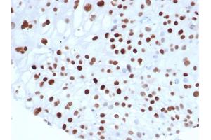 Formalin fixed paraffin embedded human colon carcinoma stained with p21 Recombinant Mouse Monoclonal Antibody (rCIP1/6907) at 2 μg/mL. (Recombinant p21 anticorps  (AA 1-100))