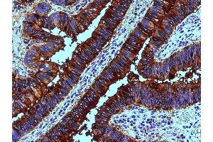 Immunohistochemistry staining of human colon adenocarcinoma (paraffin sections) using anti-blood group Lewis b (clone 2-25LE). (Blood Group Lewis B anticorps)