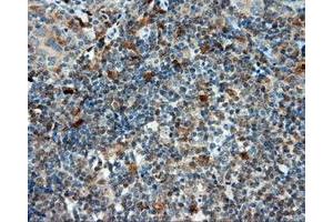 Immunohistochemical staining of paraffin-embedded Carcinoma of liver tissue using anti-LIPG mouse monoclonal antibody. (LIPG anticorps)
