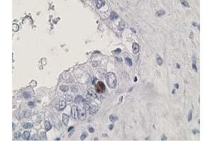 Immunohistochemical staining of paraffin-embedded Adenocarcinoma of Human ovary tissue using anti-HDHD2 mouse monoclonal antibody. (HDHD2 anticorps)