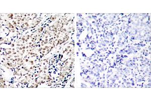 P-Peptide - +Immunohistochemical analysis of paraffin-embedded human breast carcinoma tissue using Chk1 (phospho-Ser345) antibody. (CHEK1 anticorps  (pSer345))