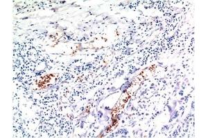 Immunohistochemical analysis of paraffin-embedded Human Breast Carcinoma Tissue using TGFβ1 Mouse mAb diluted at 1:200. (TGFB1 anticorps)