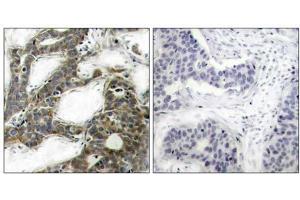 Immunohistochemical analysis of paraffin-embedded human breast carcinoma tissue, using β-Catenin (Ab-33) antibody (E021211). (beta Catenin anticorps)
