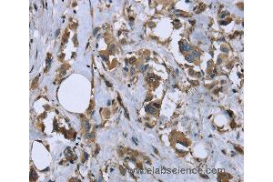 Immunohistochemistry of Human breast cancer using MYL12B Polyclonal Antibody at dilution of 1:20 (MYL12B anticorps)