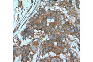 IHC analysis of paraffin-embedded human breast cancer tissue using Beclin 1 antibody at a dilution of 1:200. (Beclin 1 anticorps)