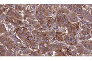 ABIN6273613 at 1/100 staining Human liver cancer tissue by IHC-P. (TNFSF18 anticorps)