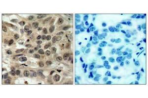 Immunohistochemical analysis of paraffin-embedded human breast carcinoma tissue, using cdc25C (Ab-216) antibody (E021145). (CDC25C anticorps)