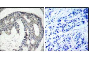Immunohistochemistry of paraffin-embedded human breast carcinoma using Phospho-NOS3-S1177 antibody (ABIN2988223). (ENOS anticorps  (pSer1177))
