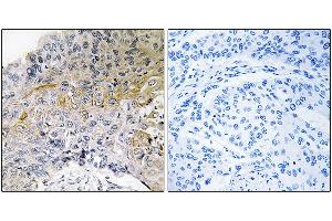 Immunohistochemical analysis of paraffin-embedded human breast carcinoma tissue using p130 Cas (Ab-410) antibody. (BCAR1 anticorps)