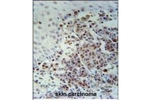 XRCC1 Antibody (Center) (ABIN651735 and ABIN2840381) immunohistochemistry analysis in formalin fixed and paraffin embedded human skin carcinoma followed by peroxidase conjugation of the secondary antibody and DAB staining. (XRCC1 anticorps  (AA 407-435))