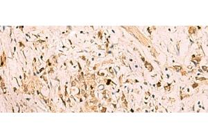 Immunohistochemistry of paraffin-embedded Human gastric cancer tissue using SGTA Polyclonal Antibody at dilution of 1:75(x200) (SGTA anticorps)