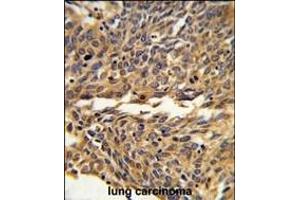 Formalin-fixed and paraffin-embedded human lung carcinoma reacted with EXOC5 Antibody (C-term), which was peroxidase-conjugated to the secondary antibody, followed by DAB staining. (EXOC5 anticorps  (C-Term))