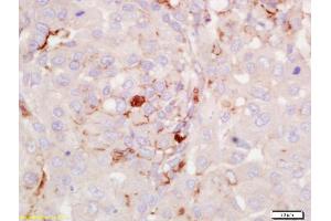 Formalin-fixed and paraffin embedded human lung carcinoma labeled with Anti-RGS2 Polyclonal Antibody, Unconjugated (ABIN669291) at 1:200 followed by conjugation to the secondary antibody and DAB staining. (RGS2 anticorps  (AA 116-211))