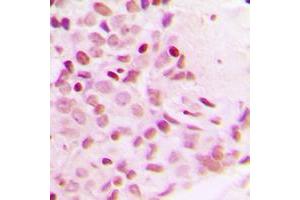 Immunohistochemical analysis of NF-kappaB p65 (pT254) staining in human breast cancer formalin fixed paraffin embedded tissue section. (NF-kB p65 anticorps  (pSer254))