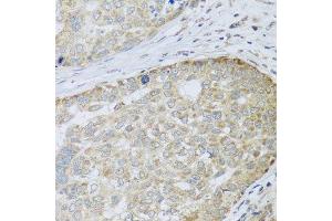 Immunohistochemistry of paraffin-embedded human liver cancer using ANAPC10 antibody. (ANAPC10 anticorps  (AA 1-185))