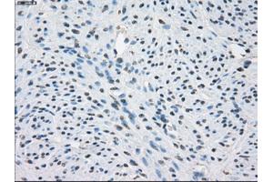 Immunohistochemical staining of paraffin-embedded Adenocarcinoma of colon tissue using anti-FCGR2A mouse monoclonal antibody. (FCGR2A anticorps)