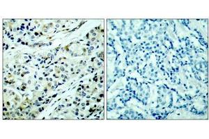 Immunohistochemical analysis of paraffin-embedded human breast carcinoma tissue, using HDAC5 (phospho-Ser498) antibody (E011193). (HDAC5 anticorps  (pSer498))