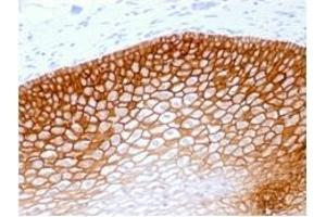 Formalin-fixed, paraffin-embedded human Cervical Squamous Cell Carcinoma stained withCD44v4 Mouse Recombinant Monoclonal Antibody (rCD44v4/1219). (Recombinant CD44 anticorps)