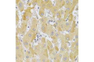 Immunohistochemistry of paraffin-embedded human liver cancer using SNAI2 Antibody (ABIN5970416) at dilution of 1/100 (40x lens). (SLUG anticorps)