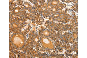 Immunohistochemistry of Human ovarian cancer using SCT Polyclonal Antibody at dilution of 1:40 (Secretin anticorps)