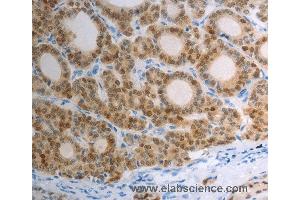 Immunohistochemistry of Human thyroid cancer using S100A1 Polyclonal Antibody at dilution of 1:40 (S100A1 anticorps)