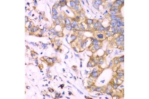 Immunohistochemistry of paraffin-embedded human liver cancer using RPS3A Antibody. (RPS3A anticorps)