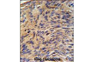 HSPA5 Antibody IHC analysis in formalin fixed and paraffin embedded human lung carcinoma followed by peroxidase conjugation of the secondary antibody and DAB staining. (GRP78 anticorps  (AA 261-289))