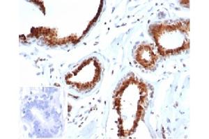Formalin-fixed, paraffin-embedded human breast carcinoma stained with p27 Recombinant Mouse Monoclonal Antibody (rKIP1/1356). (Recombinant CDKN1B anticorps)