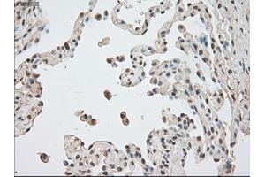 Immunohistochemical staining of paraffin-embedded Adenocarcinoma of breast tissue using anti-BUB1B mouse monoclonal antibody. (BUB1B anticorps)