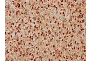 IHC image of ABIN7175822 diluted at 1:300 and staining in paraffin-embedded human glioma performed on a Leica BondTM system. (WAPAL anticorps  (AA 1037-1190))