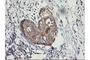 Immunohistochemical staining of paraffin-embedded Adenocarcinoma of Human breast tissue using anti-MTFMT mouse monoclonal antibody. (MTFMT anticorps  (AA 175-389))