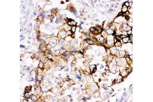 IHC-P: Heme Oxygenase 2 antibody testing of human lung cancer tissue (HMOX2 anticorps  (AA 2-316))