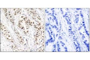 Immunohistochemical analysis of paraffin-embedded human breast carcinoma tissue, using BRCA1 (phospho-Ser1524) antibody (E011117). (BRCA1 anticorps  (pSer1524))
